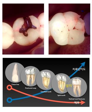 [출처] 덴포라인_대크랙 시대 큐레이의 임상활용
